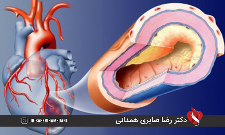 علائم آنژین پکتوریس قلبی